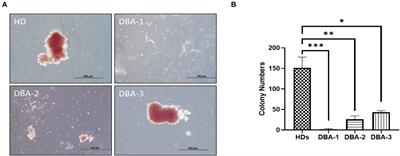 Proerythroblast Cells of Diamond-Blackfan Anemia Patients With RPS19 and CECR1 Mutations Have Similar Transcriptomic Signature